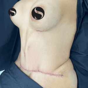 Body Lift – 18013