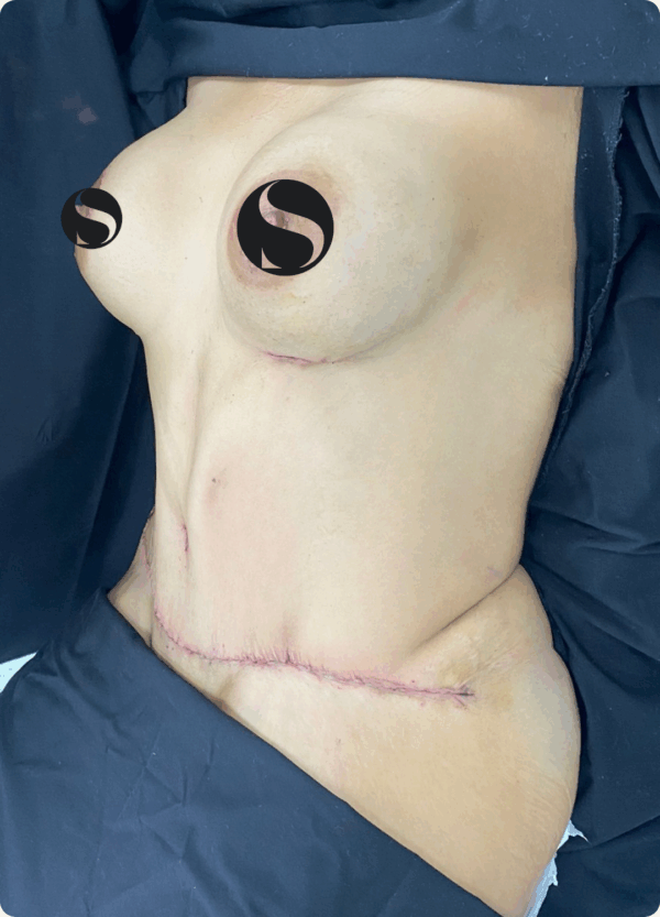 Body Lift - 18013 - Image 2