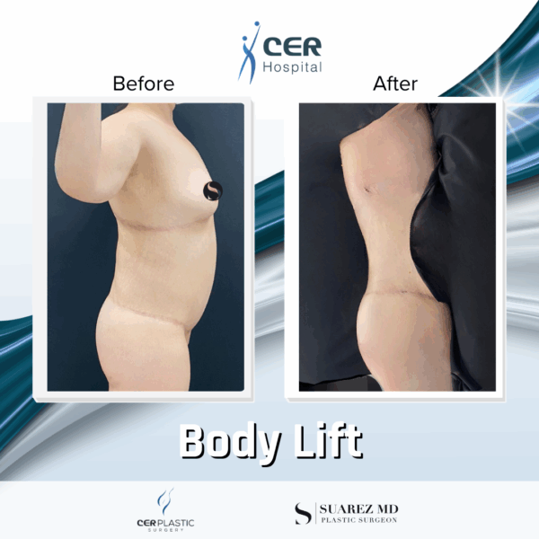 Body Lift - 20013