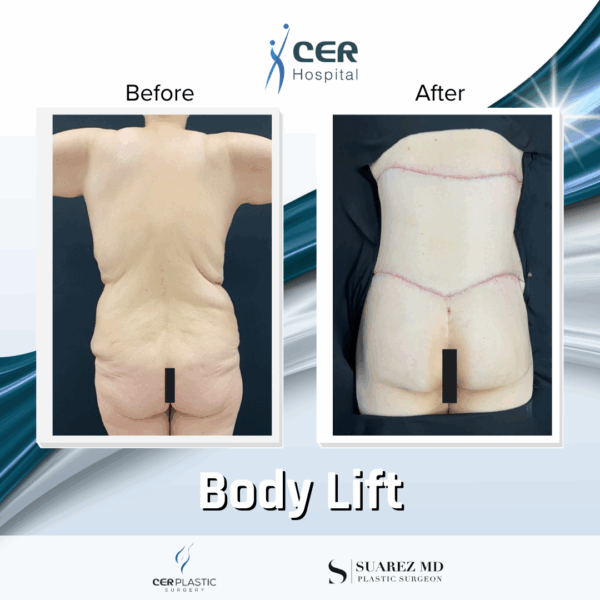 Body Lift - 20013 - Image 10