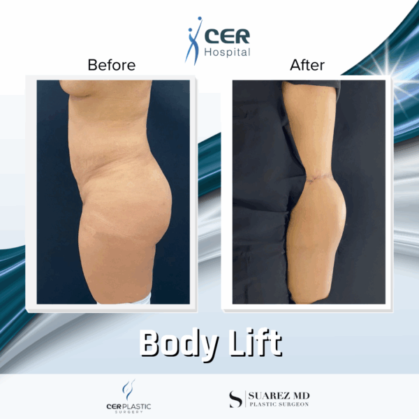 Body Lift - 26043 - Image 10