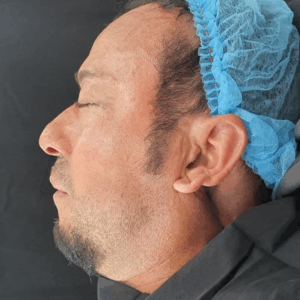 Lower Eyelid Surgery – 21043