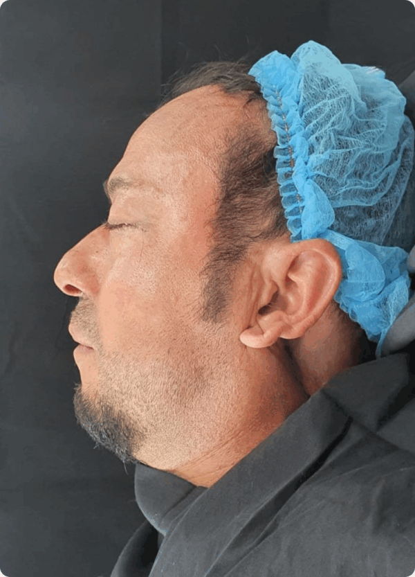 Lower Eyelid Surgery - 21043 - Image 2