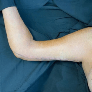 Body Lift – 18094
