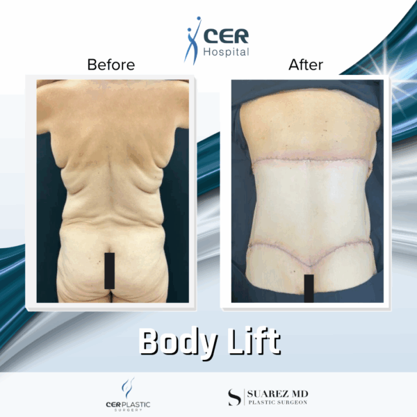 Body Lift - 9104 - Image 7