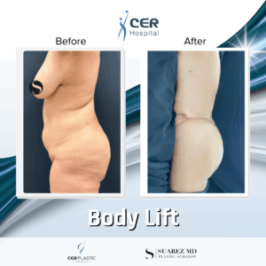 Body Lift – 20084