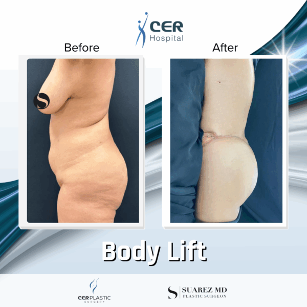 Body Lift - 20084