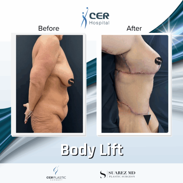 Body Lift - 0608 - Image 10