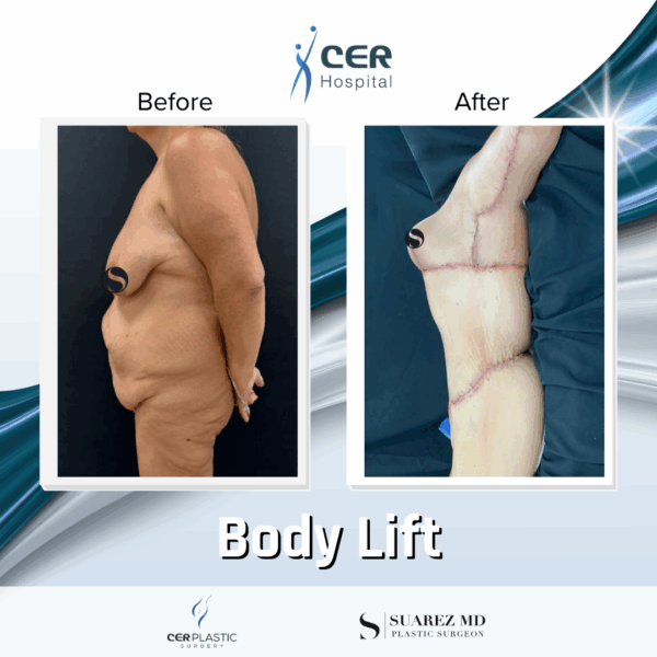 Body Lift - 31074 - Image 10