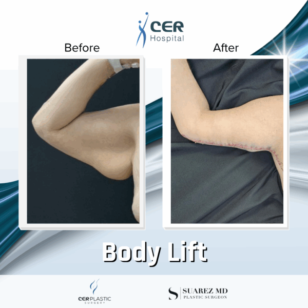 Body Lift - 24104 - Image 10