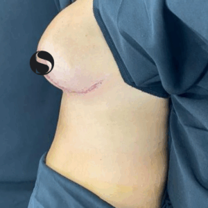 Breast Lift with Implant Exchange – 28104