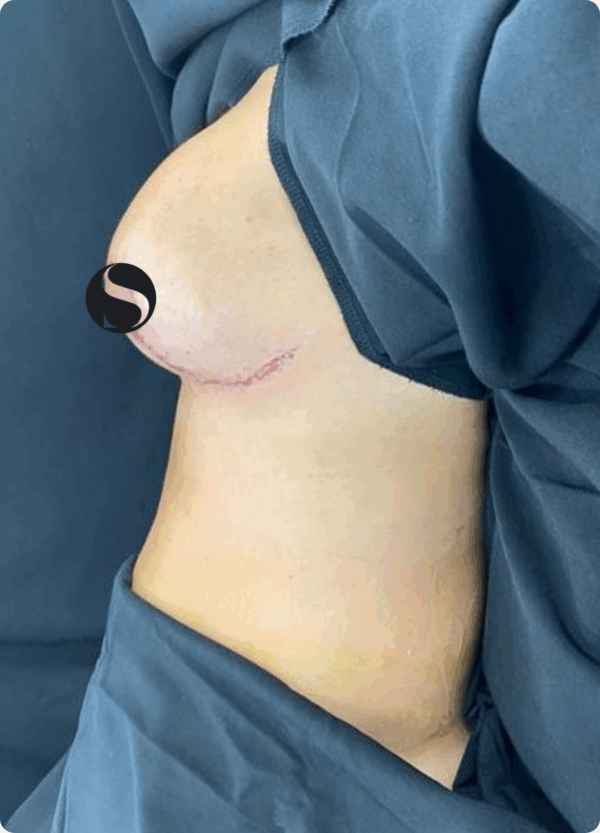 Breast Lift with Implant Exchange - 28104 - Image 2