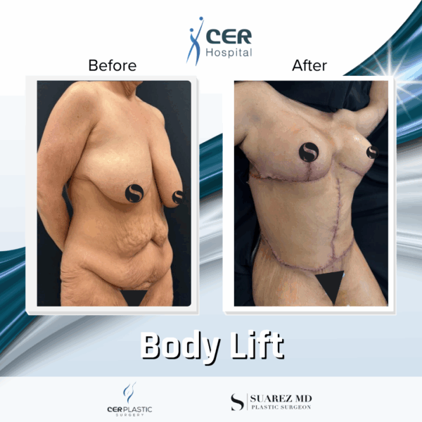 Body Lift - 0608 - Image 11