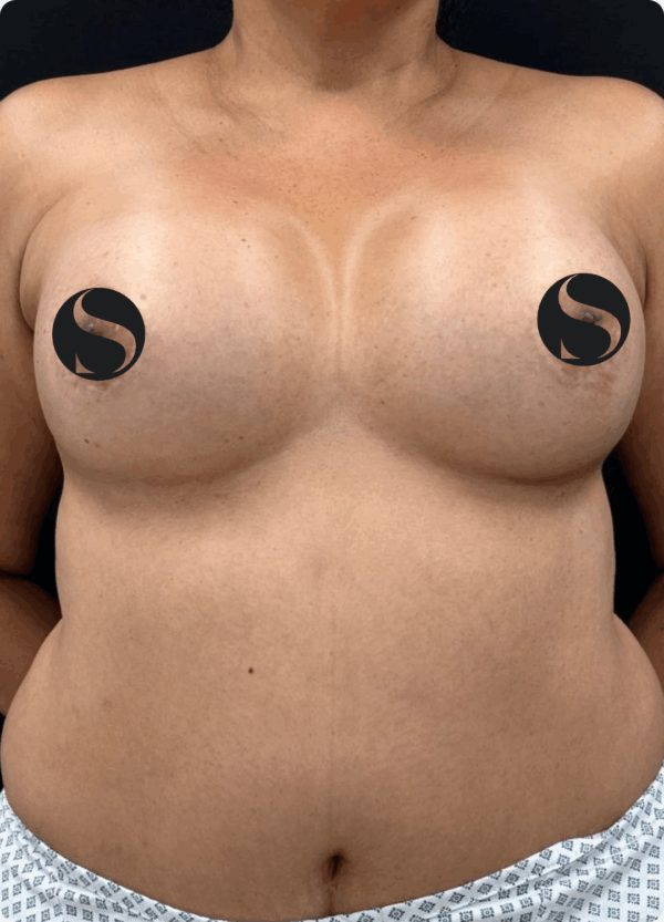 Implant Exchange - 24054 - Image 3