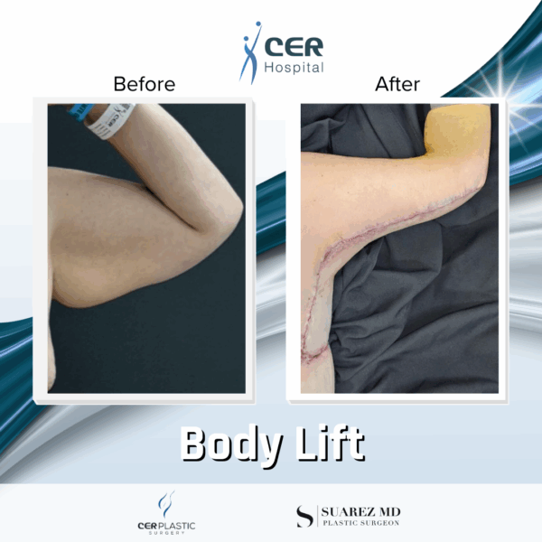 Body Lift - 24104 - Image 11