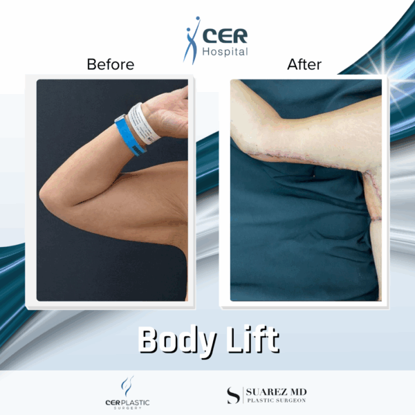 Body Lift - 31074 - Image 11