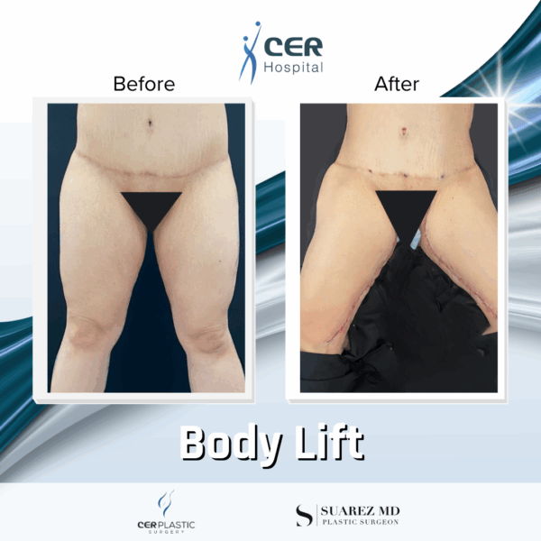 Body Lift - 20013 - Image 11