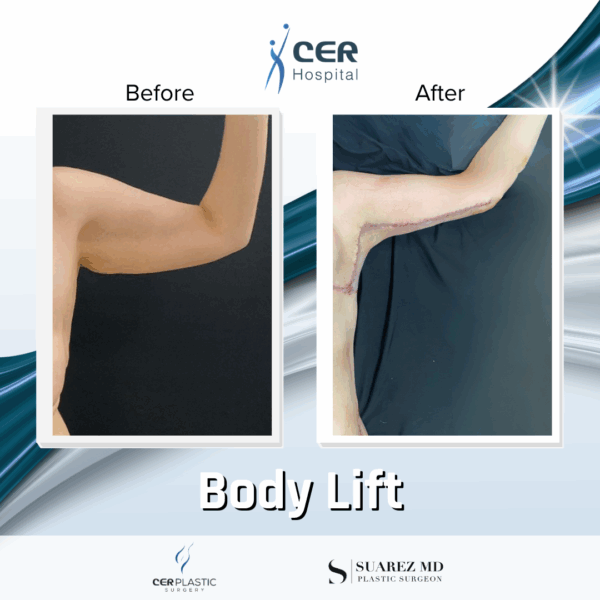 Body Lift - 20013 - Image 11