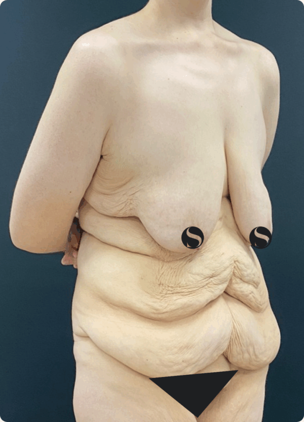 Body Lift - 20013 - Image 3