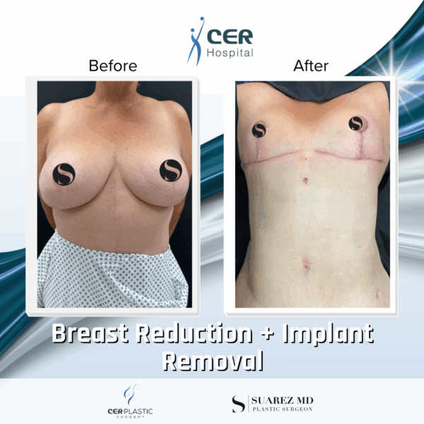 Breast Reduction with Implant Removal - 30094