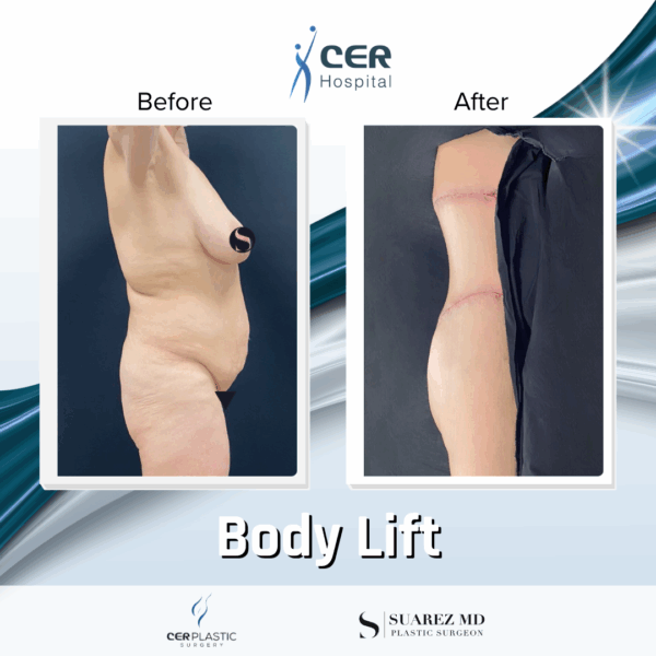 Body Lift - 15053 - Image 4
