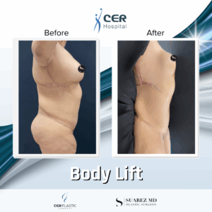 Body Lift – 05063