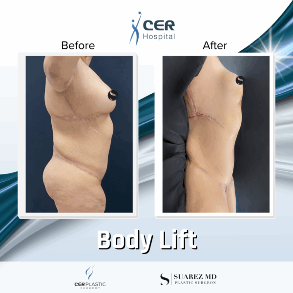 Body Lift - 05063 - Image 4