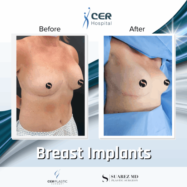 Breast Implant - 05063 - Image 4