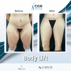 Body Lift – 12063