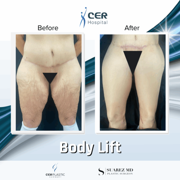 Body Lift - 12063 - Image 4