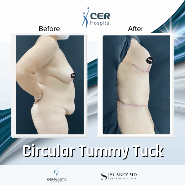 Circular Tummy Tuck - 05073 - Image 4