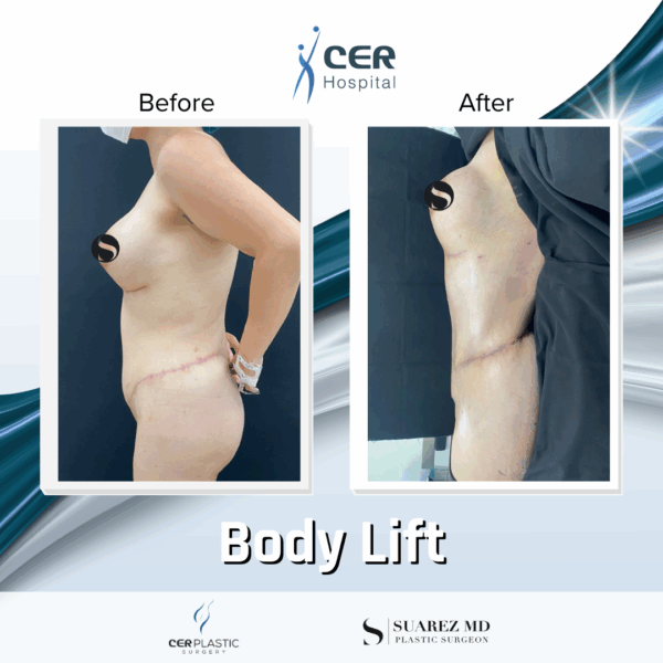 Body Lift - 14073 - Image 4