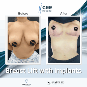 Breast Lift with Implants – 30063