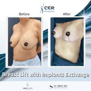 Breast Lift with Implant Exchange – 09063