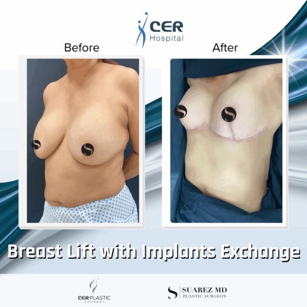 Breast Lift with Implant Exchange - 09063 - Image 4