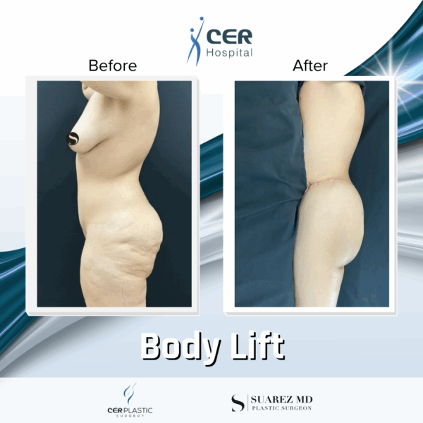 Body Lift - 039 - Image 9