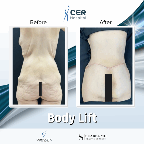 Body Lift - 019 - Image 4