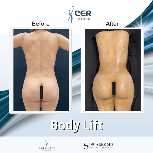 Body Lift - 30053 - Image 4
