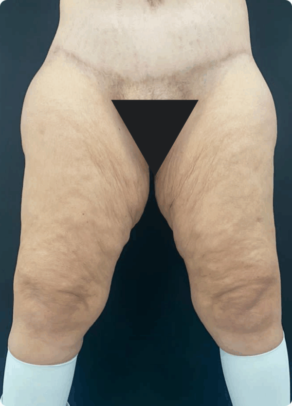 Extended Thigh Lift - 06113 - Image 3