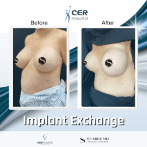 Implant Exchange – 09063