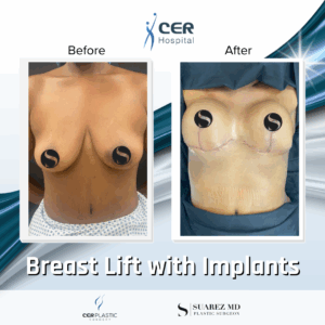 Breast Lift with Implants – 02063