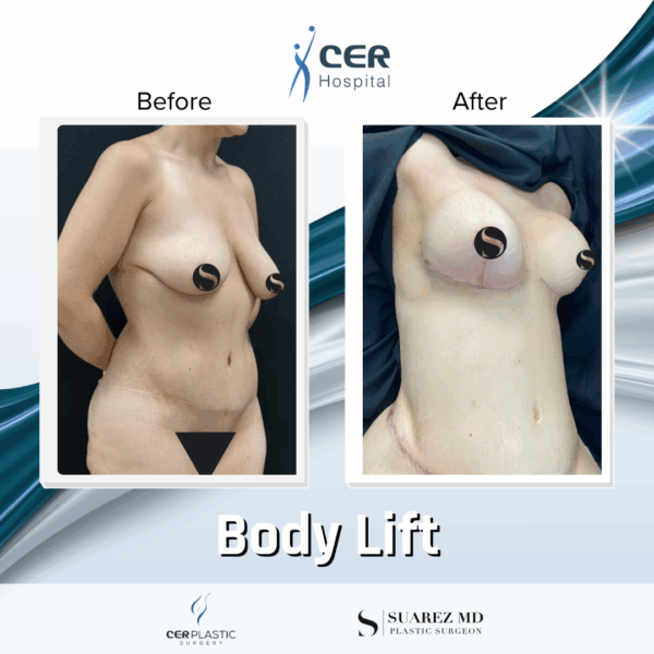 Body Lift - 039 - Image 12