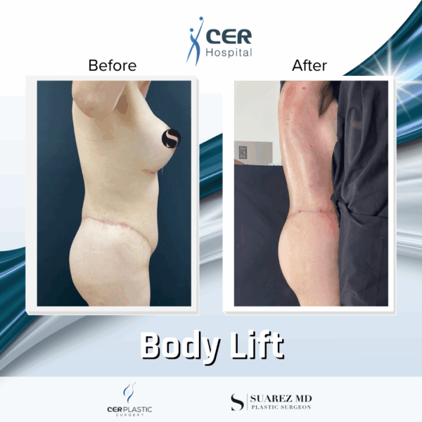 Body Lift - 14073 - Image 12