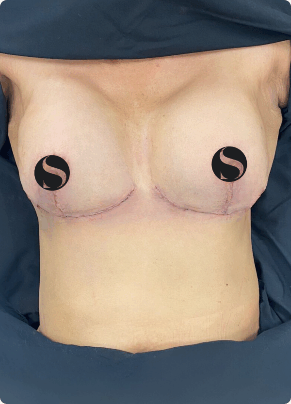 Breast Lift with Implant Exchange - 09063 - Image 2
