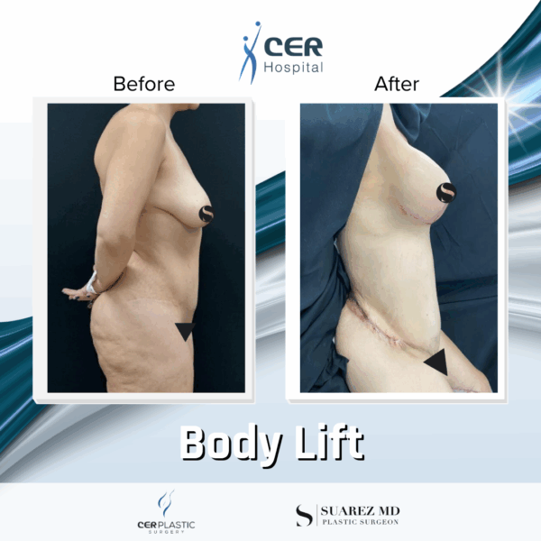 Body Lift - 039 - Image 13