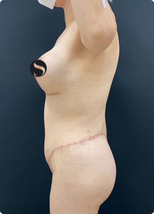 Body Lift - 14073 - Image 3
