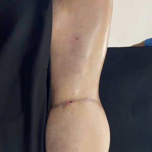 Body Lift – 14073