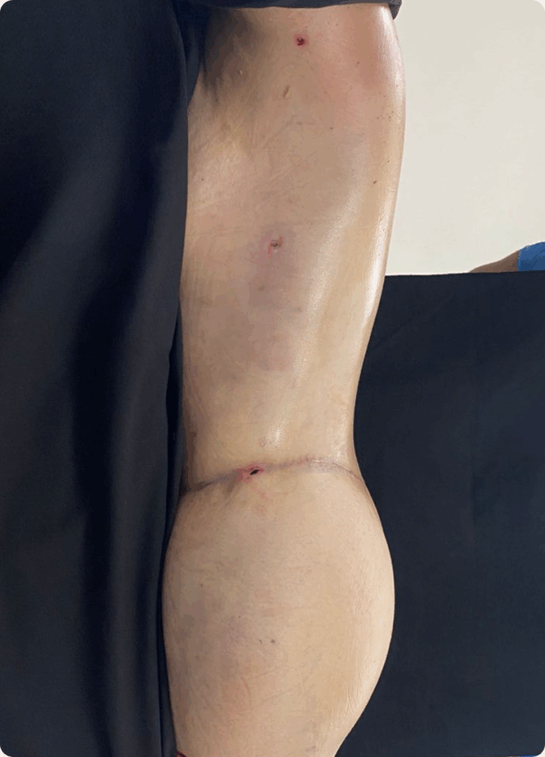 Body Lift - 14073 - Image 2