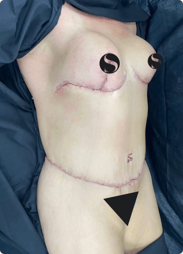 Body Lift - 15053 - Image 2