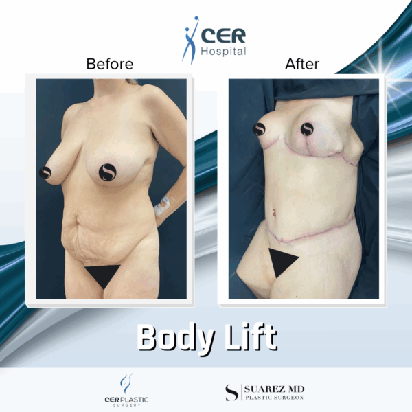 Body Lift - 15053 - Image 5